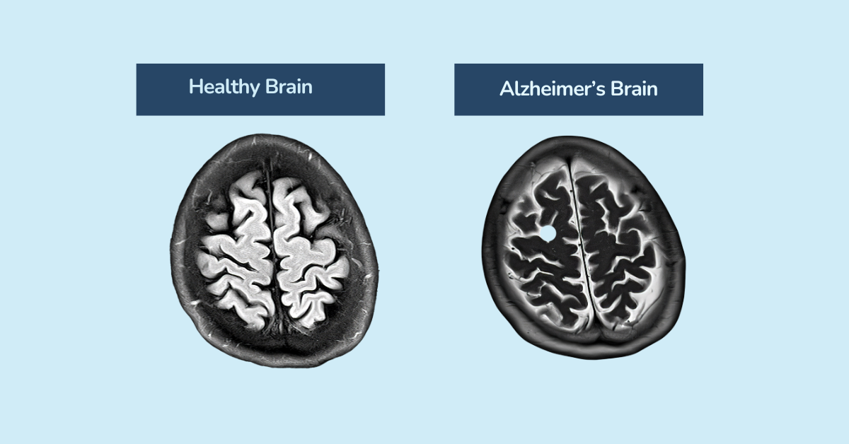 How does Alzheimer's disease affect the brain?